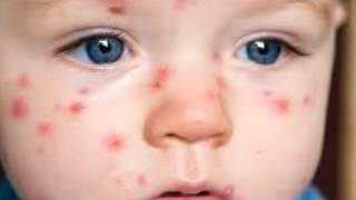 What is chickenpox Signs and symptoms of chickenpox [upl. by Reid175]