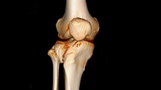 Proximal Tibia Lateral Condyle Fracture [upl. by Sheepshanks]