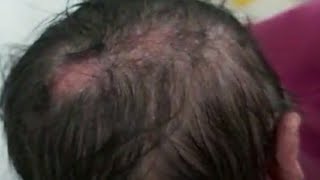 case575 scalp heal atrophic hairless fibrotic aplasia cutis congenita with solitary epidermal naevus [upl. by Inahpit655]