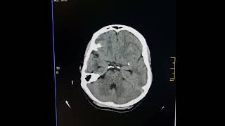 Cyst of cavum septum pellucidum causing mild obstructive hydrocephalus [upl. by Gibbie601]