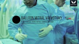 Balloon Mitral Valvotomy [upl. by Geibel]