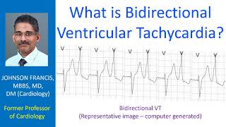 What is bidirectional ventricular tachycardia [upl. by Nosiaj]