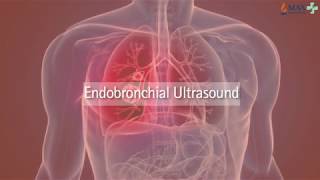 Whats is EBUS  Endobronchial Ultrasound Ebus  Max Hospital [upl. by Kissie]