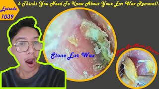 6 Things You Need To Know About Earwax Removal Ep 1039 earwax [upl. by Debra]