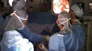 Video Assisted Thoracic Surgery VATS [upl. by Rinaldo]