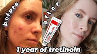 how Tretinoin saved my skin pictures included [upl. by Rheingold563]