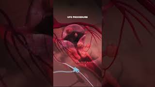 What is Uterine Fibroid Embolization procedure Types of Fibroids fibroid pregnancy animation [upl. by Yentterb701]