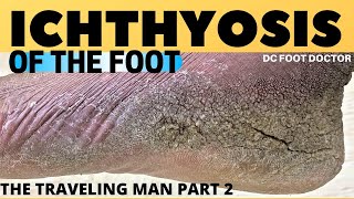 Ichthyosis of the Foot Travelin Mans Severe Skin Condition and Treatment [upl. by Diskson349]