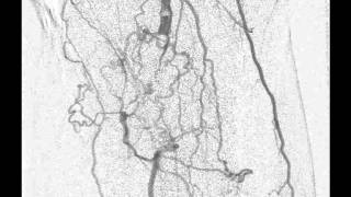 Arteriografia de membros inferiores  CIMI [upl. by Persas]