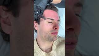 Microneedling facial at Dr Medispa [upl. by Ehudd279]