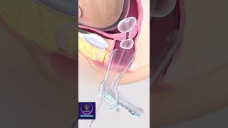 Cervical Dilation amp Curettage  Cervix Opening with Balloon shorts [upl. by Rebecka]