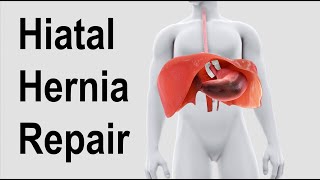 Hiatal Hernia Repair Animation [upl. by Gentry]