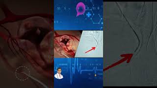 Uterine Fibroid Embolization Live Surgery [upl. by Hocker924]