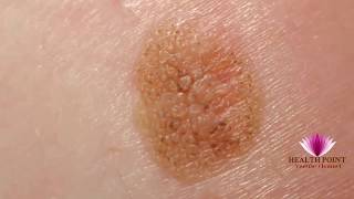 Melanoma Pictures  Signs Symptoms Causes Photos Images Pictures of Melanoma Skin Cancer [upl. by Aiuqet948]