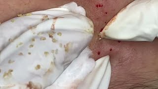 Big Cystic Acne Blackheads Extraction Blackheads amp Milia Whiteheads Removal Pimple Popping [upl. by Dacy]