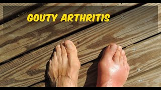 Gouty arthritis  joint pain [upl. by Snoddy]