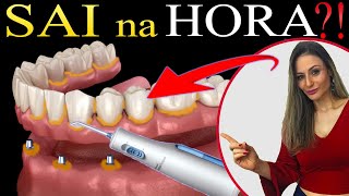 Técnica MATADORA pra Limpar Protocolo ou Prótese sobre Implantes Limpa mesmo [upl. by Klockau36]