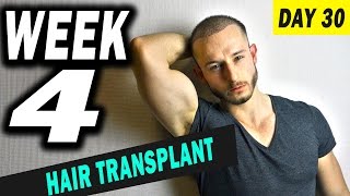 FUE Hair Transplant 1 Month post op Istanbul Turkey [upl. by Nylednarb342]