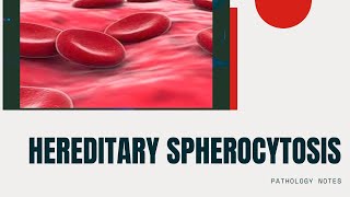 HEREDITARY SPHEROCYTOSISNOTES ON HEREDITARYSPHEROCYTOSISPATHOLOGY OF HEREDITARY SPHEROCYTOSIS [upl. by Enibas234]