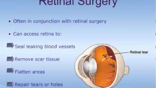 Vitrectomy [upl. by Enalb278]