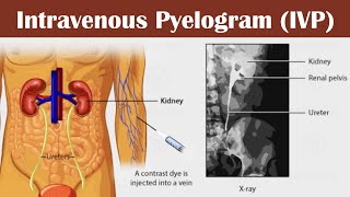 Intravenous pyelogram IVP [upl. by Westland]