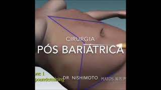 Abdominoplastia reversa  mamoplastia redutora em pósbariátrica [upl. by Rehtnug]