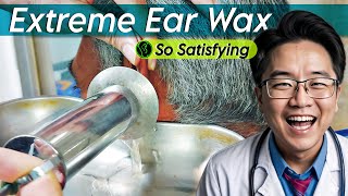 Extreme Ear Wax Removal earwaxremoval earwaxremoving earwax [upl. by Griselda]