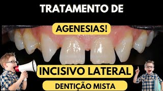 Tratamento de AGENESIA DE INCISIVO LATERAL substituído pelo canino permanente  Aula 147 [upl. by Lyrahs]