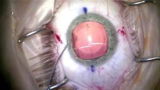 Implantable Collamer Lens Visian ICL implantation [upl. by Licha]