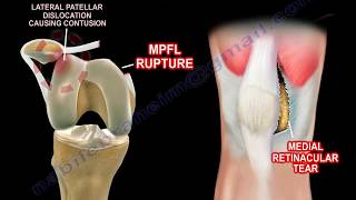 Basic Anatomy Of The Patella  Everything You Need To Know  Dr Nabil Ebraheim [upl. by Tamra742]