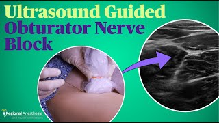 Ultrasound Guided Obturator Nerve Block [upl. by Enna]