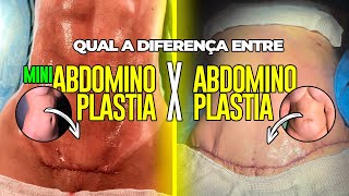 QUAL A DIFERENÇA DE ABDOMINOPLASTIA PARA A MINIABDOMINOPLASTIA [upl. by Darill824]