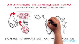 Nephrology – Generalized Edema By Timothy Yau MD and Michael Connor MD [upl. by Emmalynne832]