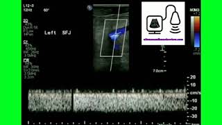 Monophasic Doppler Waveform [upl. by Nauqahs]