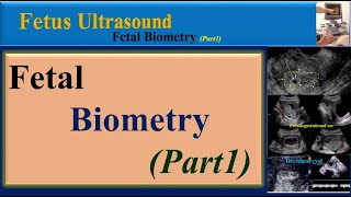 Fetus Ultrasound Fetal BiometryPart1 [upl. by Ru514]