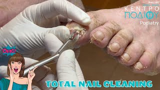 Total Nail Cleaning feet toe κεντροποδιου foot podologos calluses podiatrist corn footcare [upl. by Aihsele]