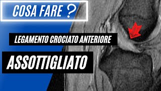 Legamento crociato anteriore assottigliato 🟠  Cosa Significa❓ [upl. by Legnaleugim]