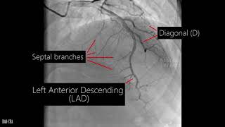 Coronary artery anatomy  Coronary angiogram [upl. by Lotz37]