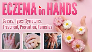 Eczema on Hands Causes Types Pictures Symptoms Treatment Natural Remedy  Hand Dermatitis [upl. by Floro]