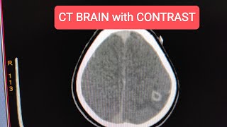 Neurocysticercosis NCC CT Scan Brain with Contrast [upl. by Eerej908]