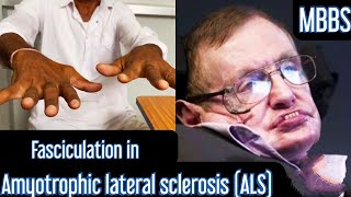 Fasciculation in Amyotrophic lateral sclerosis ALS mbbs medicine neet usmle aiims next [upl. by Auehsoj]