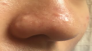 how to get rid of nose acne bumps easy [upl. by Capps]