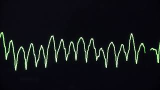 Cardiac arrest rhythms VF VT Asystole and PEA [upl. by Chong]