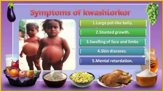 04 Nutrition and their Deficiency Diseases 5th evs [upl. by Farica]