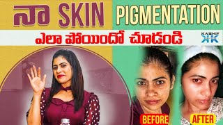 నా SKIN PIGMENTATION ఎలా పోయిందో చూడండి  RJ Kajal  Kashif Kreations [upl. by Fulbright]