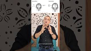 सिर में यह गैप कैसे आ गया Post Craniectomy Bone Defect NeuroMedTalks01 neurosurgeon brain [upl. by Gideon]