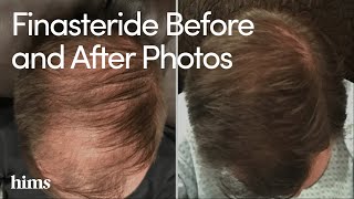 Finasteride Results Finasteride Before and After Photos [upl. by Erfert]