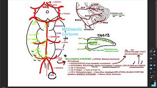 Wallenberg Syndrome  Strokes  Part 2 [upl. by Grati886]