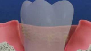 Periodontal Disease amp Treatment [upl. by Zuleika961]