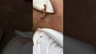 Big Cystic Acne Blackheads Extraction Blackheads amp Milia Whiteheads Removal Pimple Popping shorts [upl. by Magavern680]